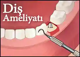 Diş Ameliyatı